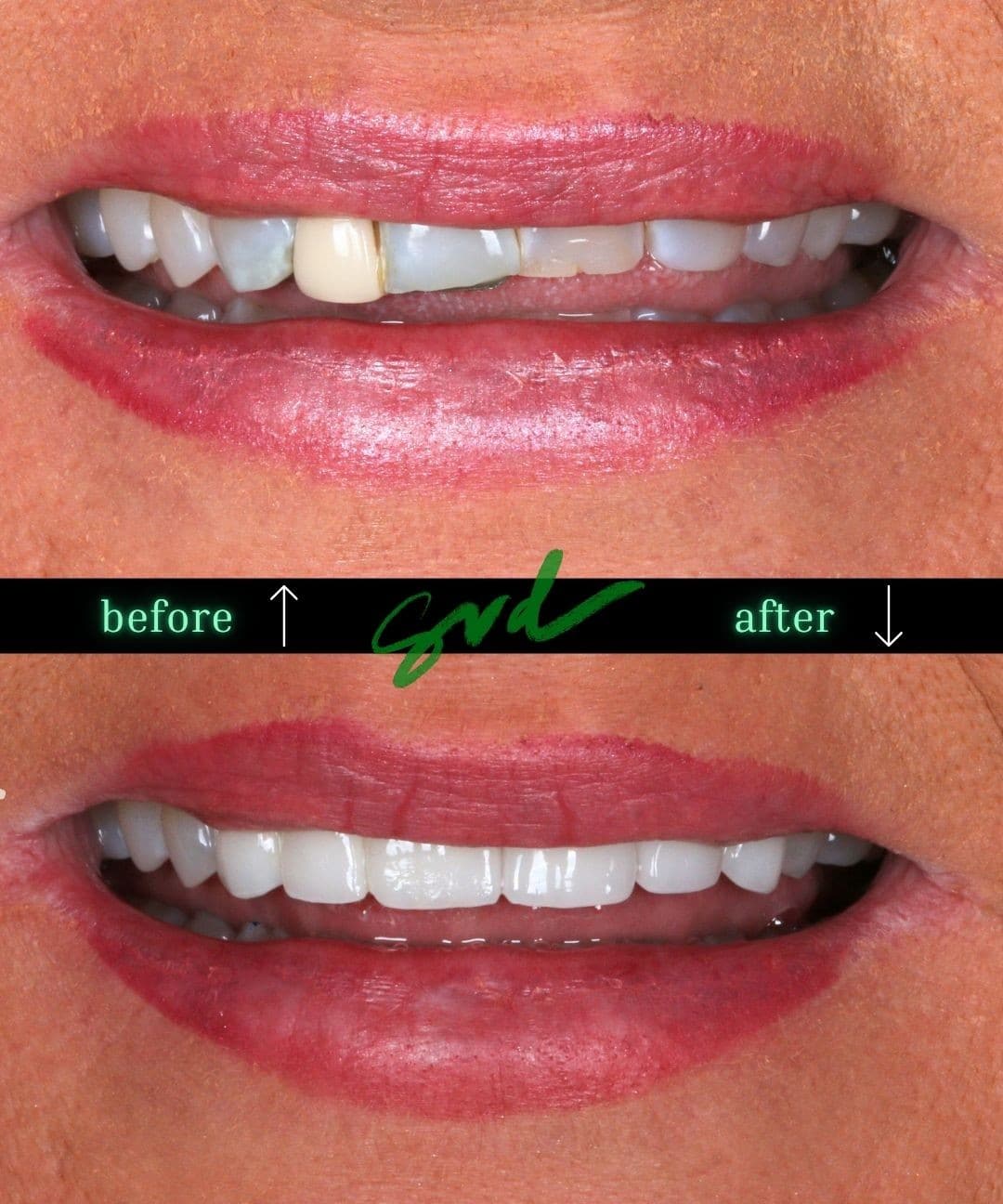 Before and After Image: Cosmetic Dentistry - front