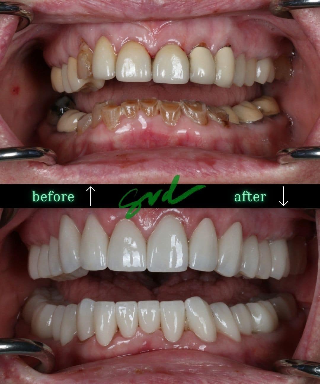 Before and After Image: FMR - front