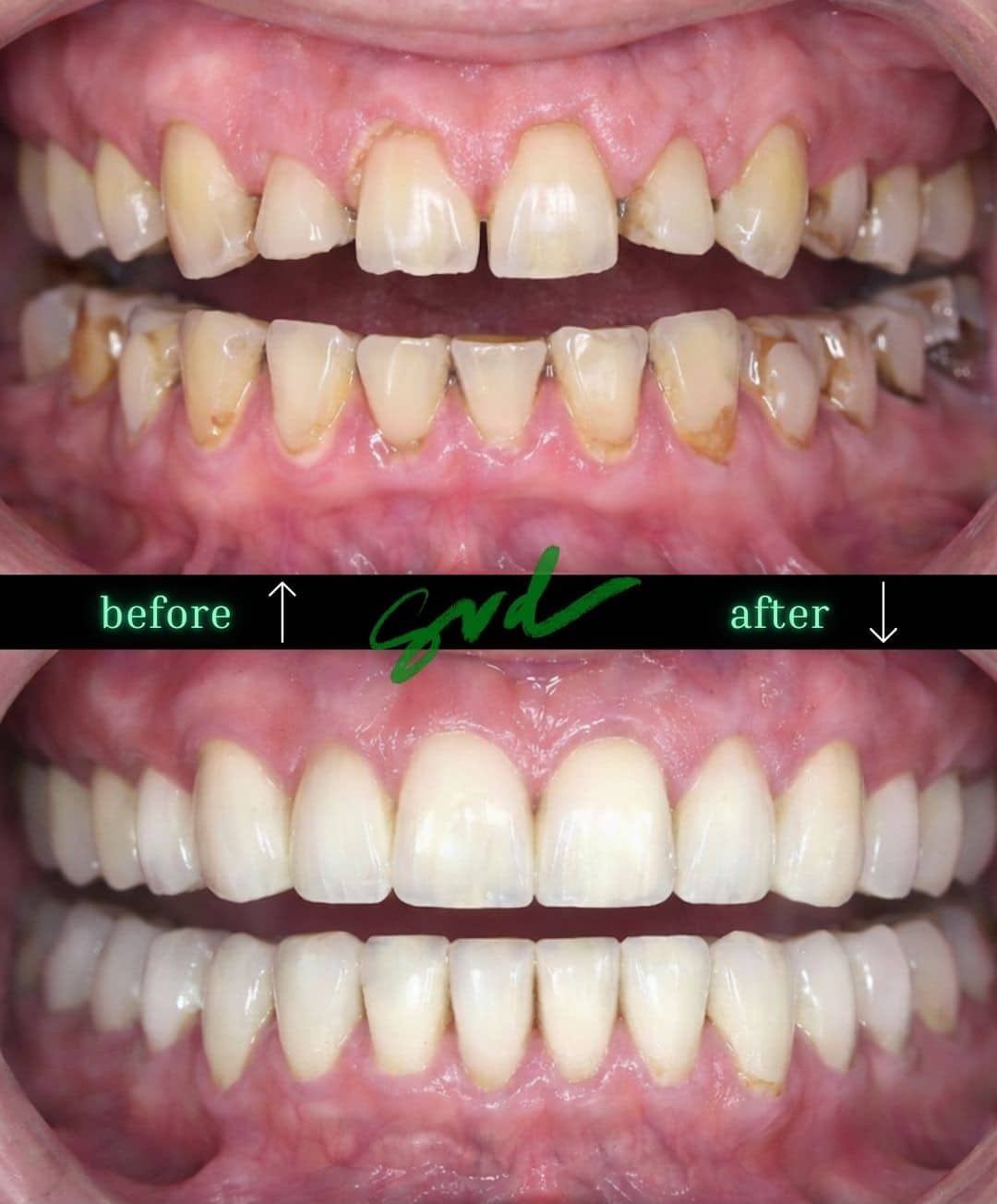 Before and After Image: FMR - front