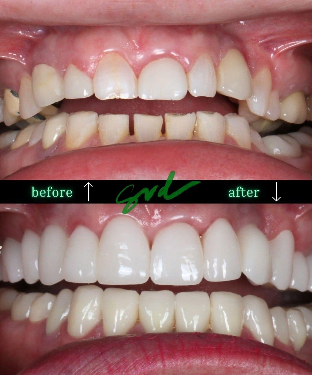 Before and After Image: FMR - front