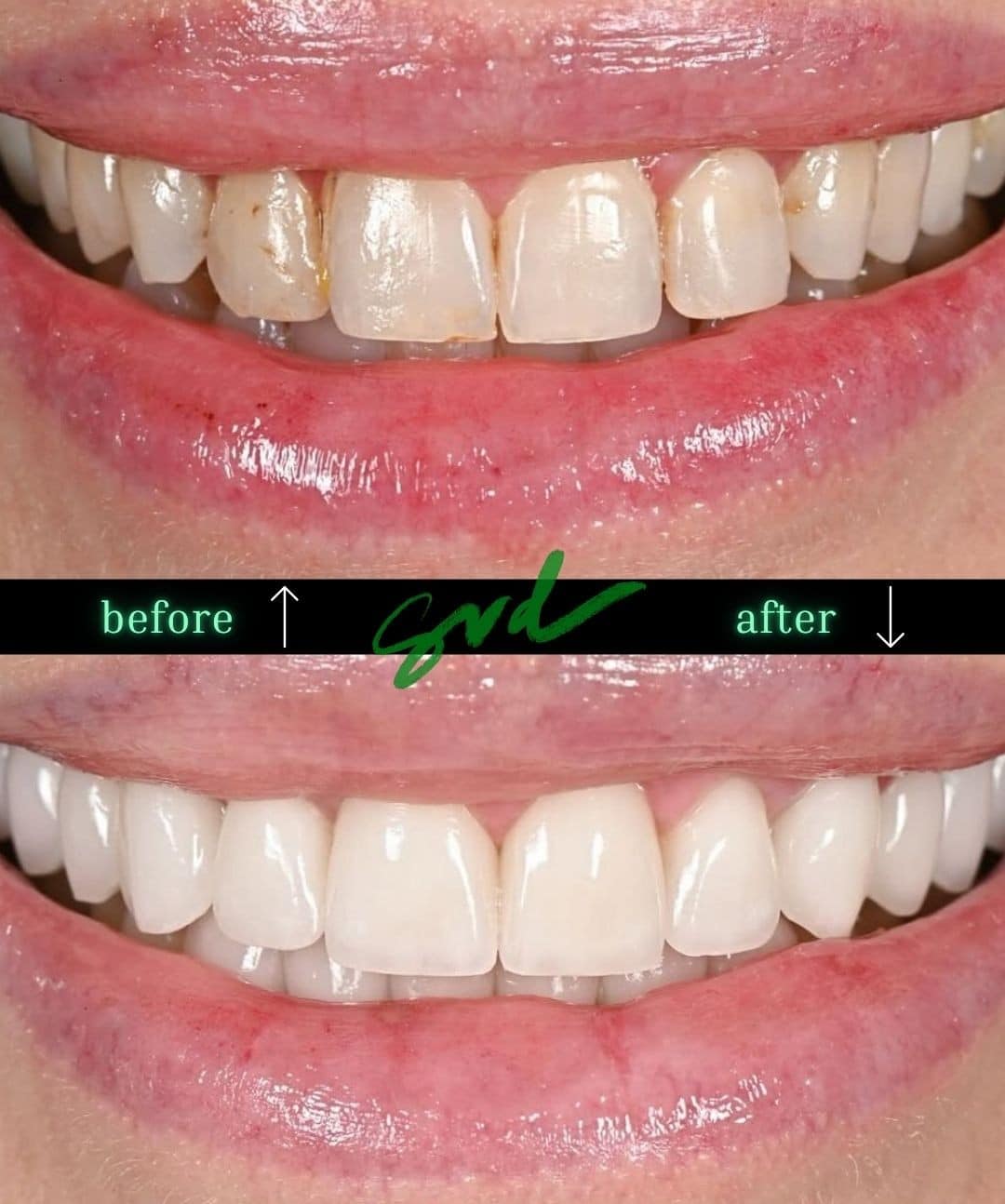 Before and After Image: Porcelain Veneers - front