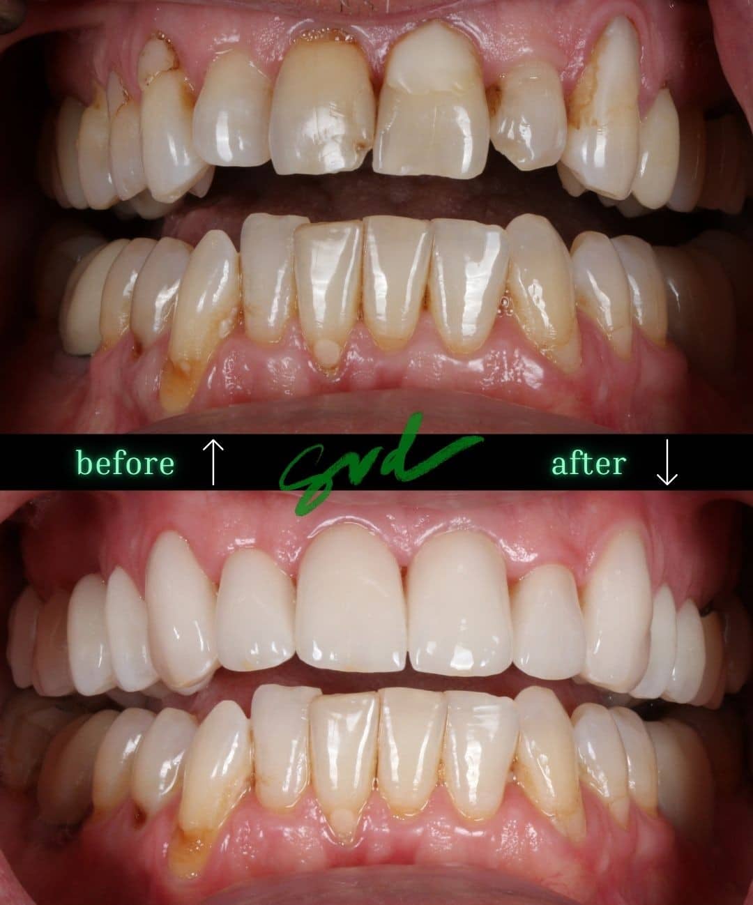 Before and After Image: Porcelain Veneers - front
