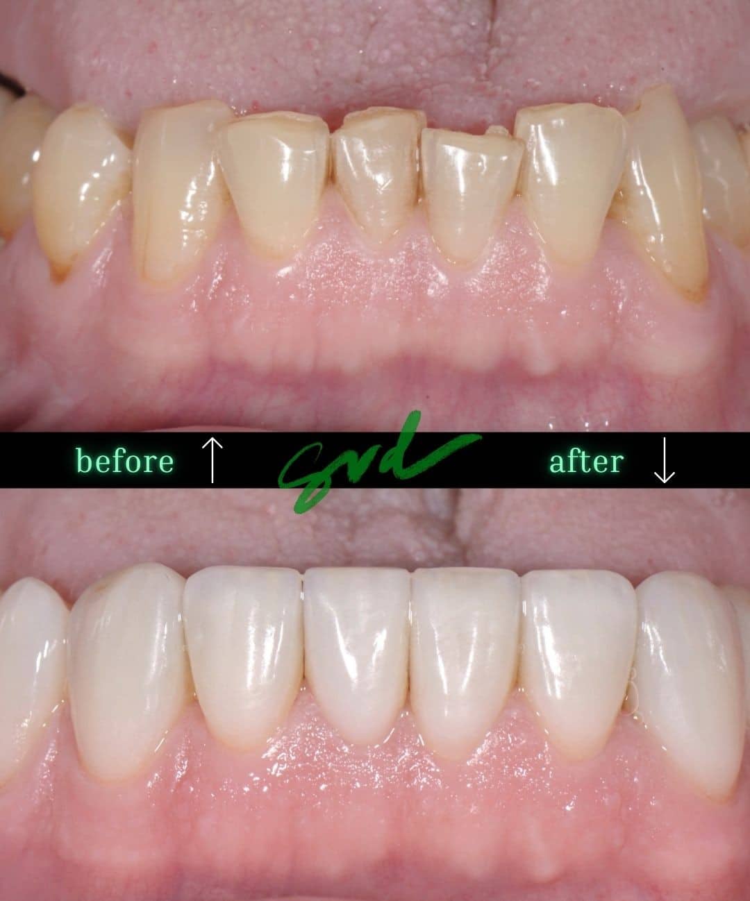 Before and After Image: Porcelain Veneers - front
