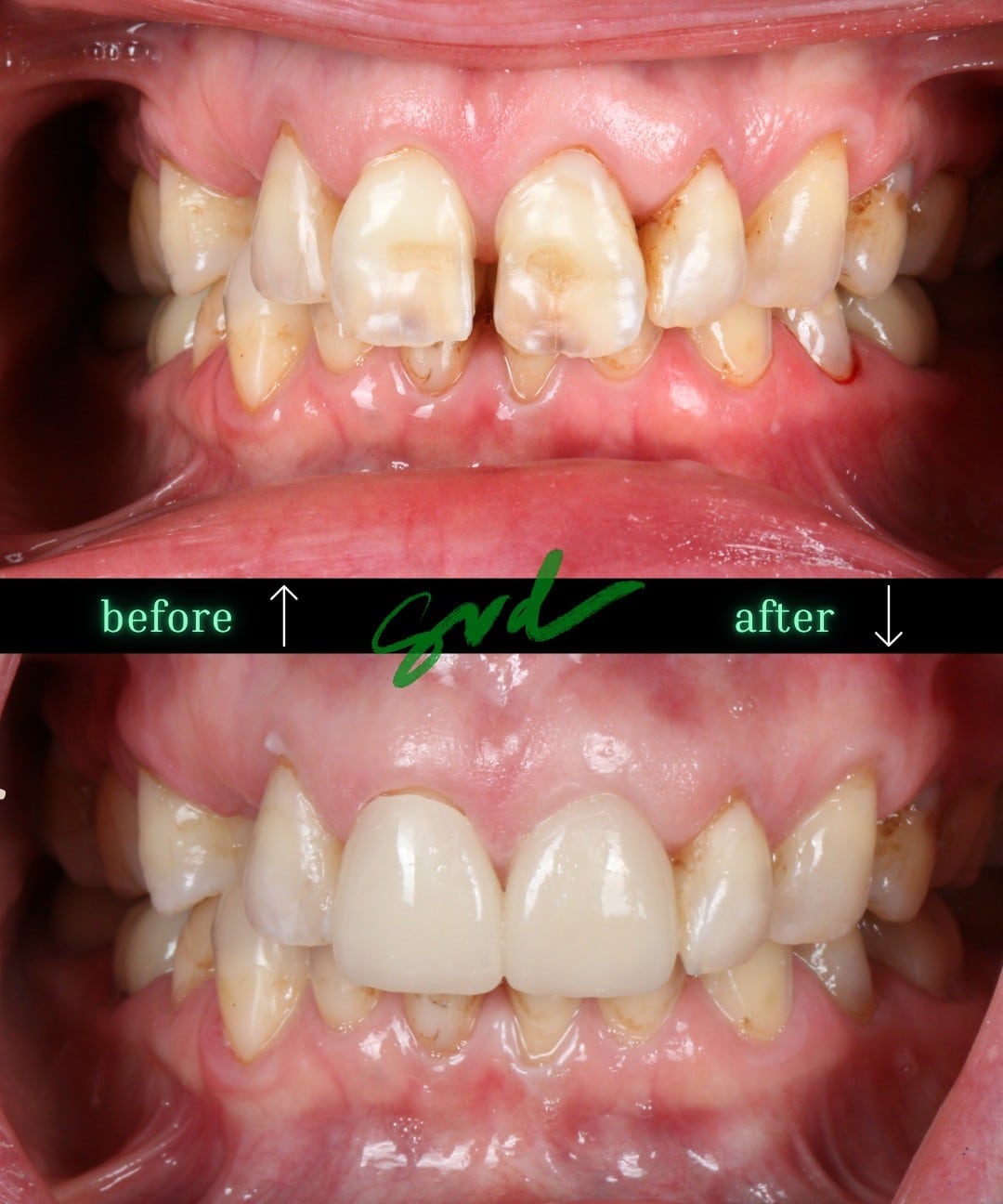 Before and After Image: Cosmetic Dentistry - front