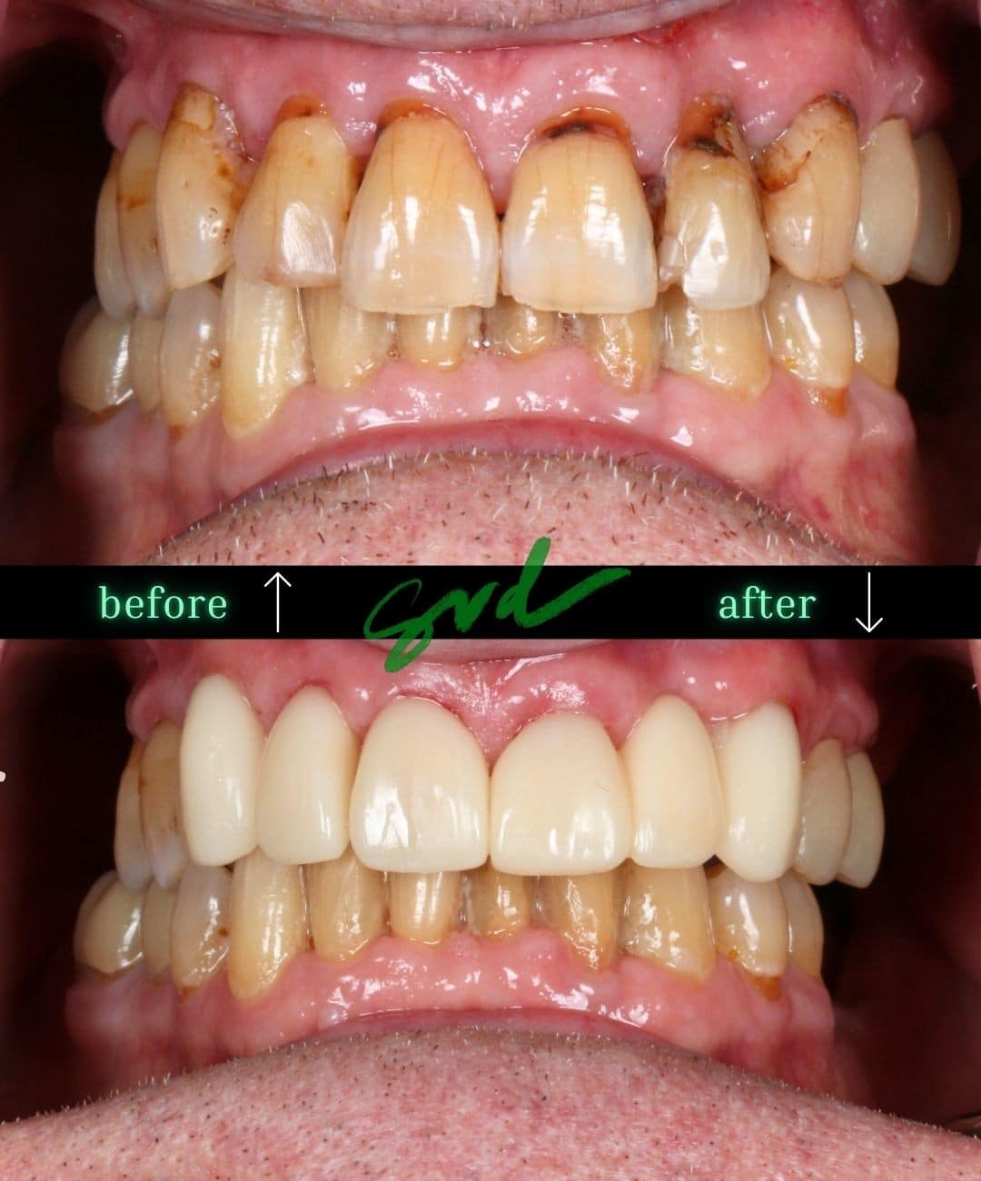 Before and After Image: Cosmetic Dentistry - front