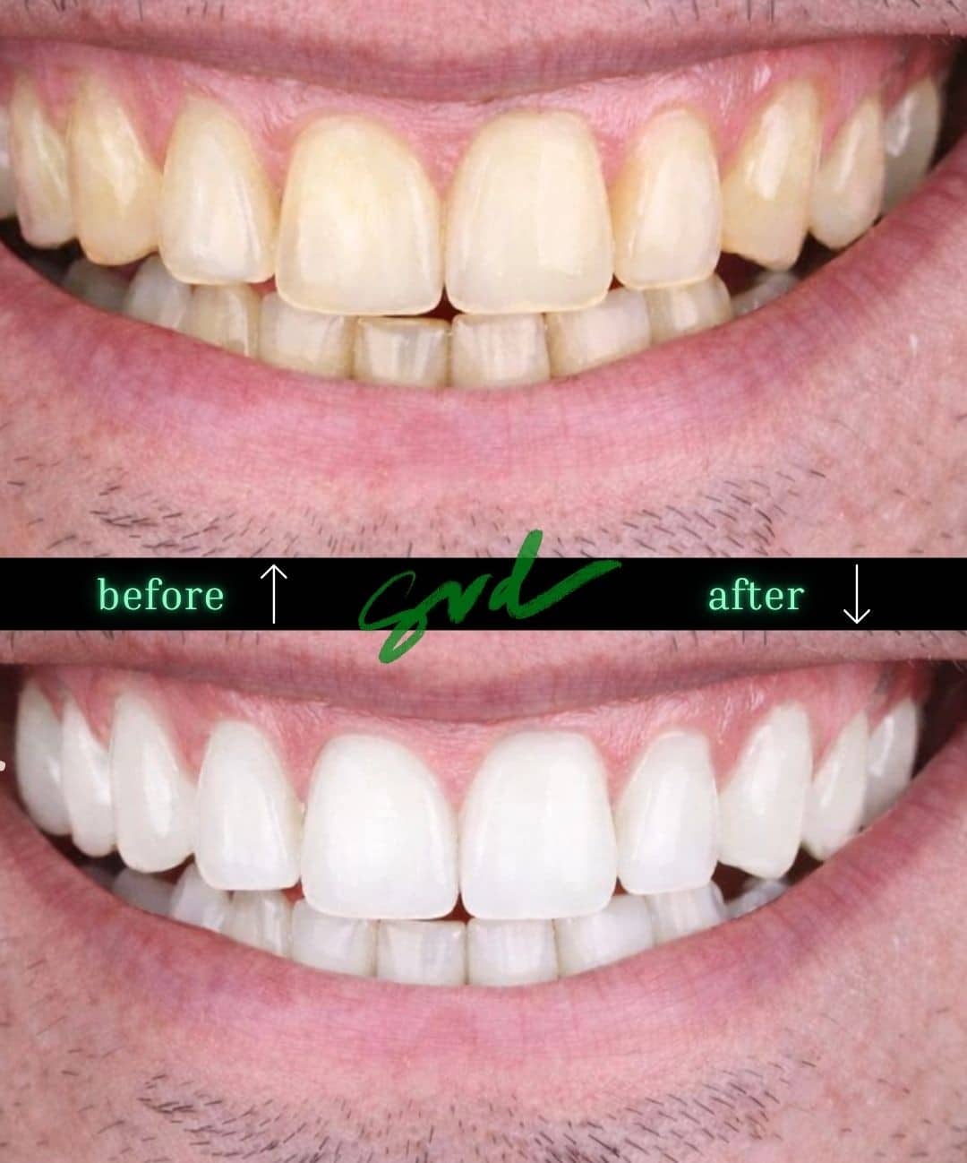 Before and After Image: Cosmetic Dentistry - front