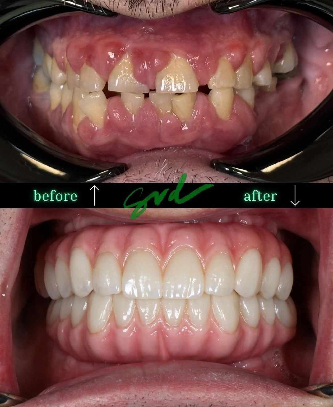 Before and After Image: NTT – All-on-X - front