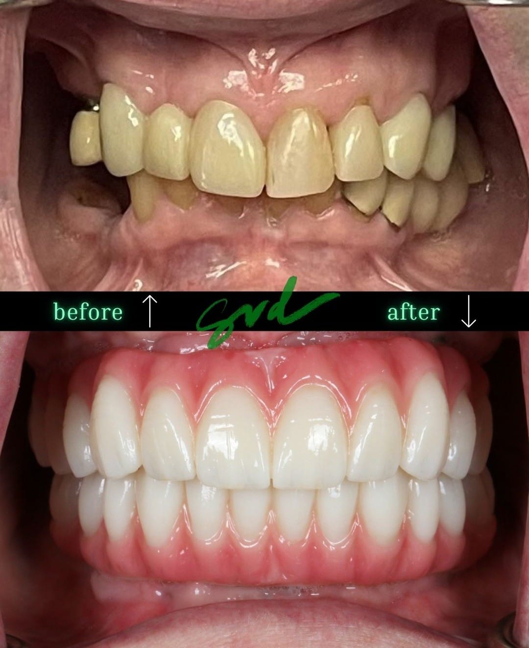 Before and After Image: NTT – All-on-X - front