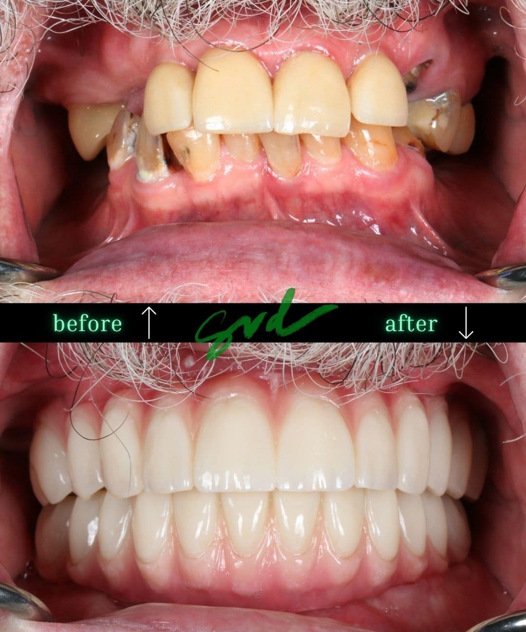 Before and After Image: NTT – All-on-X - front