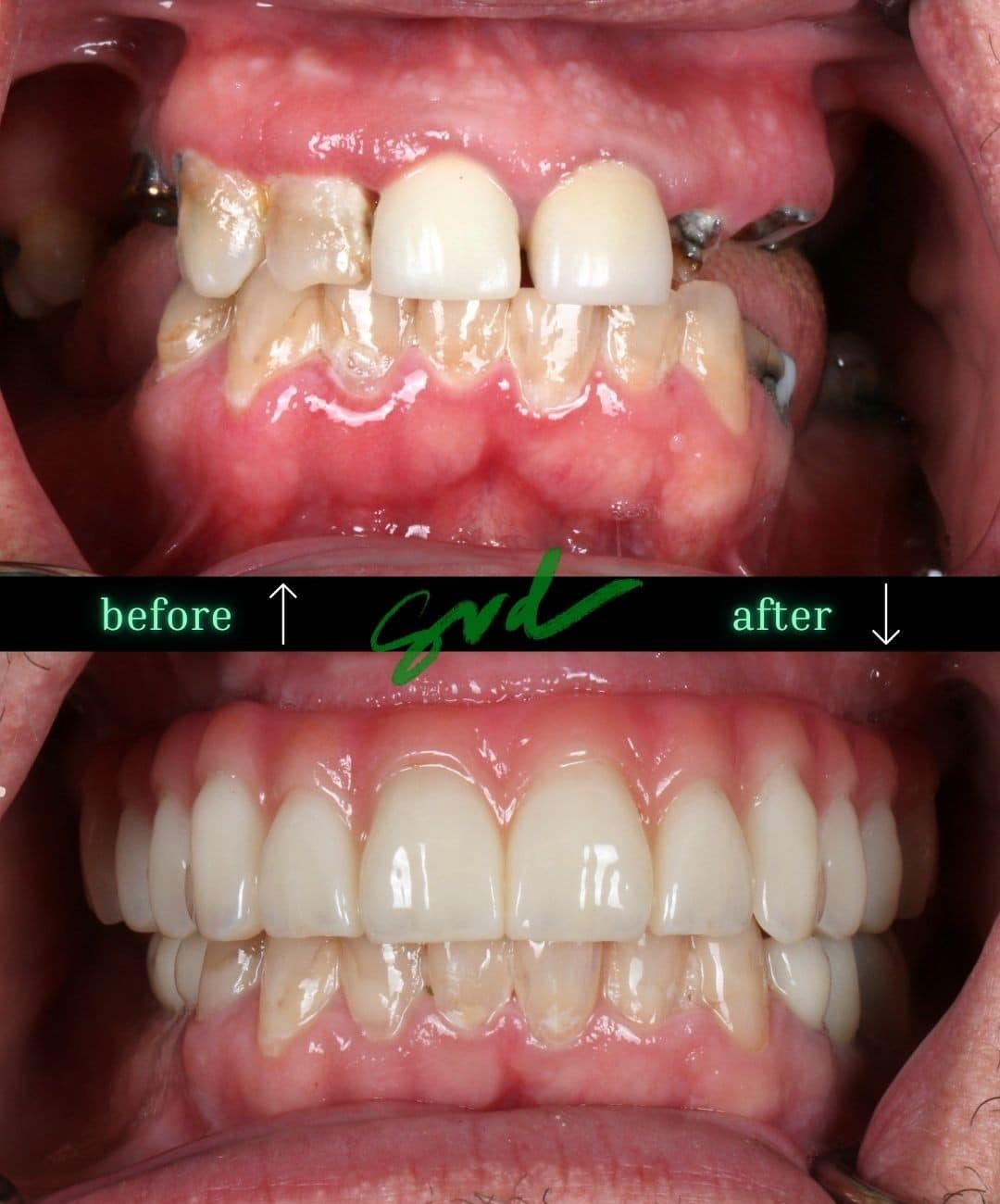 Before and After Image: NTT – All-on-X - front
