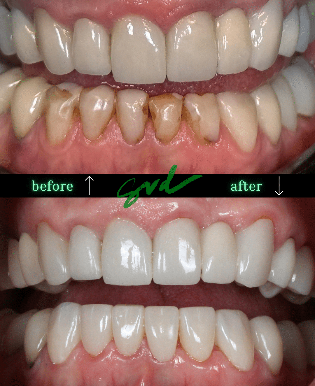 Before and After Image: Porcelain Veneers - front